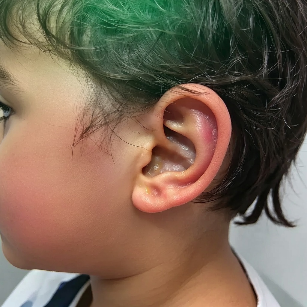 Trattamento mirato Otite Media Effusiva con CILIACELL